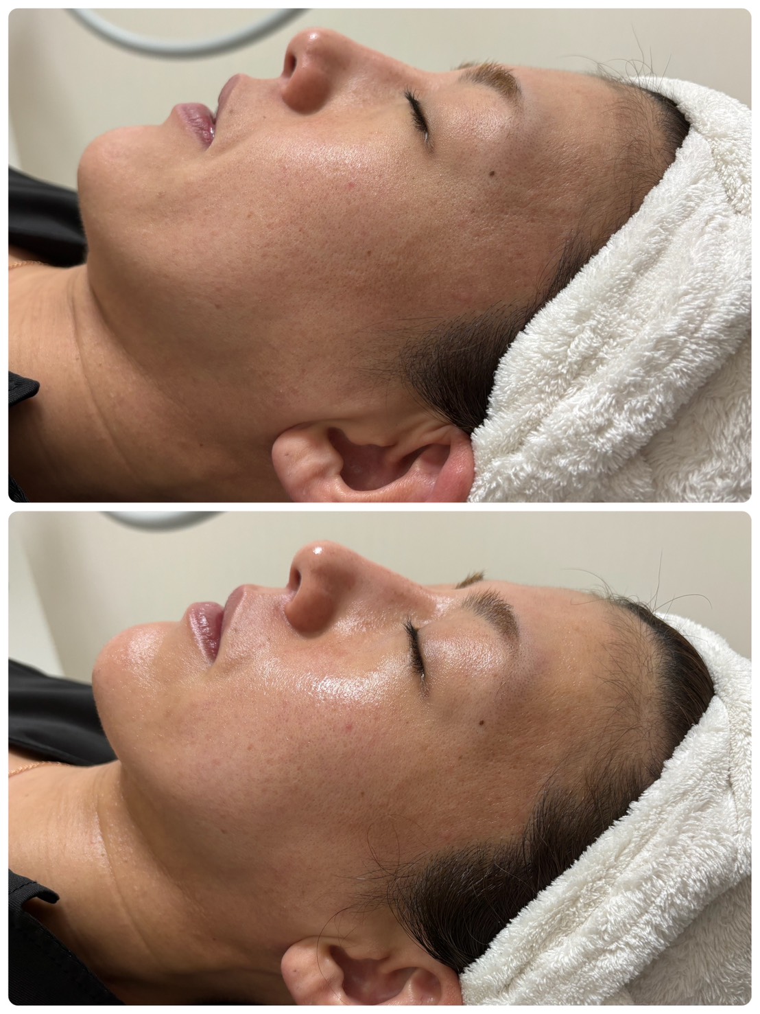In Core Shape™ フェイスラインの変化 BEFORE / AFTER
